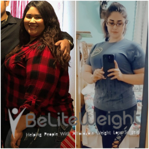 Weight Loss Surgery Before And After